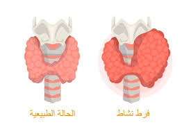 فرط نشاط الغدة الدرقية